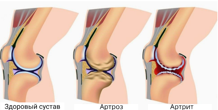 Артрит и артроз ног