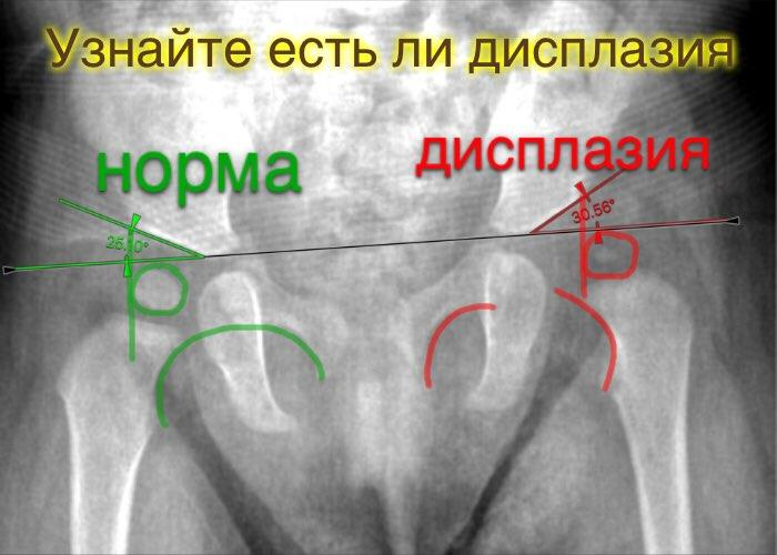 сравнение рентгеновских снимков дисплазия суставов